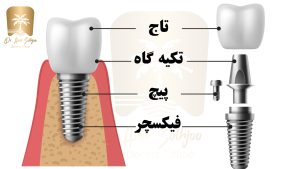 ایمپلنت دندان چیست