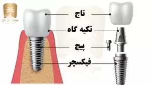 ایمپلنت دندان چیست