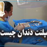 ایمپلنت دندان چیست؟