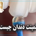 لمینت دندان چیست
