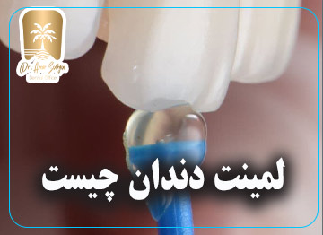 لمینت دندان چیست