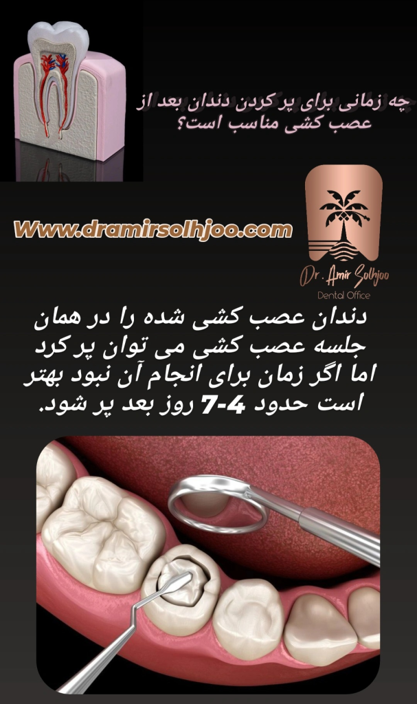 زمان پر کردن دندان عصب کشی شده