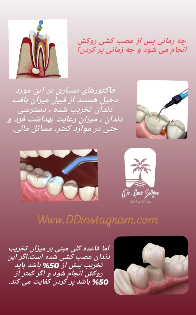 چقدر باید دندون پوسیده باشه تا دندان رو پر کنیم