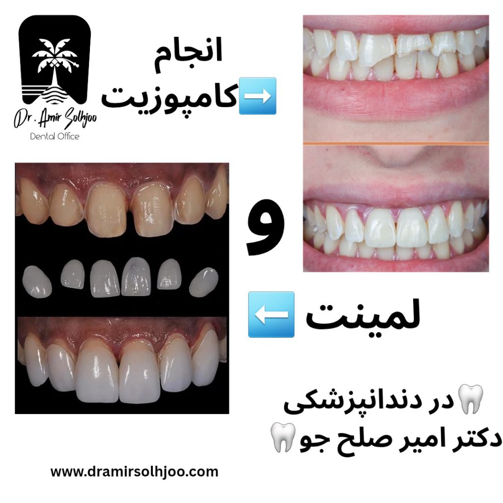 لمینت و کامپوزیت