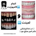 فرق لمینت و کامپوزیت