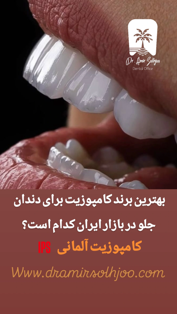 بهترین برند کامپوریت دندان جلو