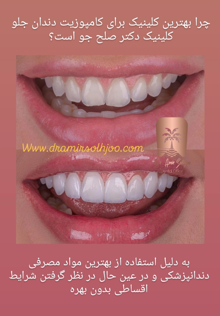 بهترین کلینیک کامپوزیت دندان جلو در تهران