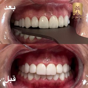 عکس قبل و بعد کامپوزیت ونیر