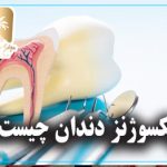 اپکسوژنز دندان
