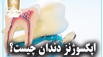 اپکسوژنز دندان