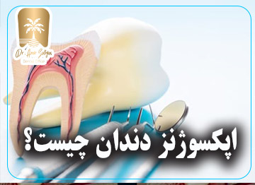 اپکسوژنز دندان