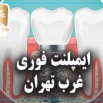 ایمپلنت فوری غرب تهران