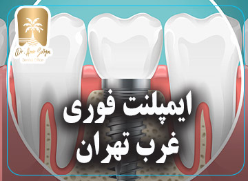 ایمپلنت فوری غرب تهران