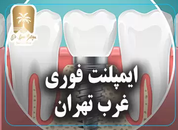 ایمپلنت فوری غرب تهران