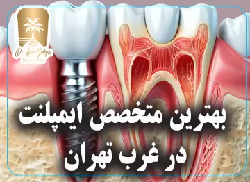 بهترین متخصص ایمپلنت در غرب تهران