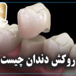 روکش دندان چیست