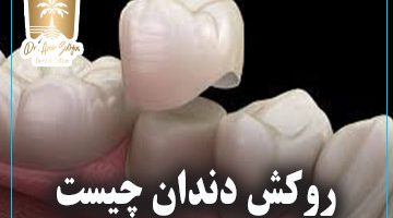 روکش دندان چیست