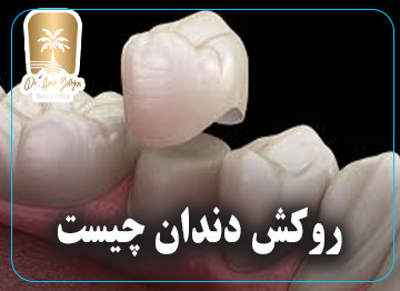 روکش دندان چیست