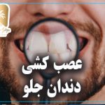 عصب کشی دندان جلو