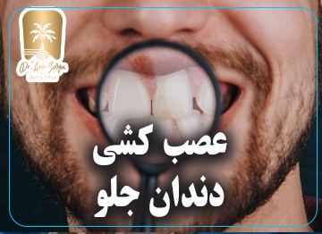 عصب کشی دندان جلو