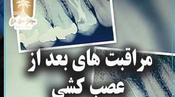 مراقبت های بعد از عصب کشی