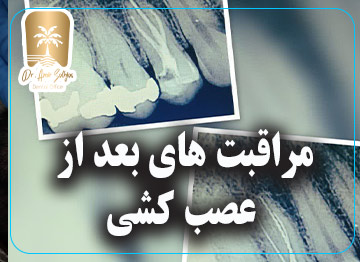 مراقبت های بعد از عصب کشی