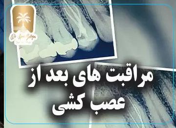 مراقبت های بعد از عصب کشی