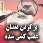پر کردن دندان عصب کشی شده