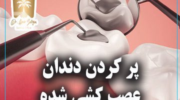 پر کردن دندان عصب کشی شده