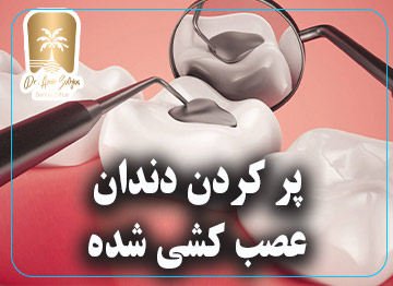 پر کردن دندان عصب کشی شده