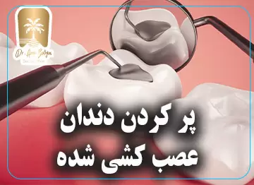 پر کردن دندان عصب کشی شده