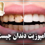 کامپوزیت دندان چیست