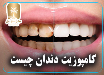 کامپوزیت دندان چیست