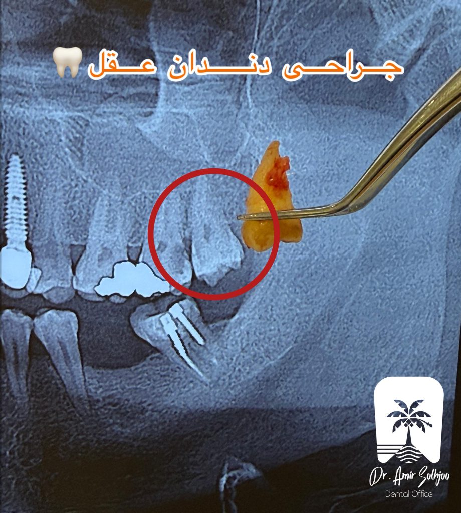 جراحی دندان عقل