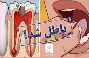 عصب کشی دندان با سیر