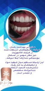 عوارض کامپوزیت دندان