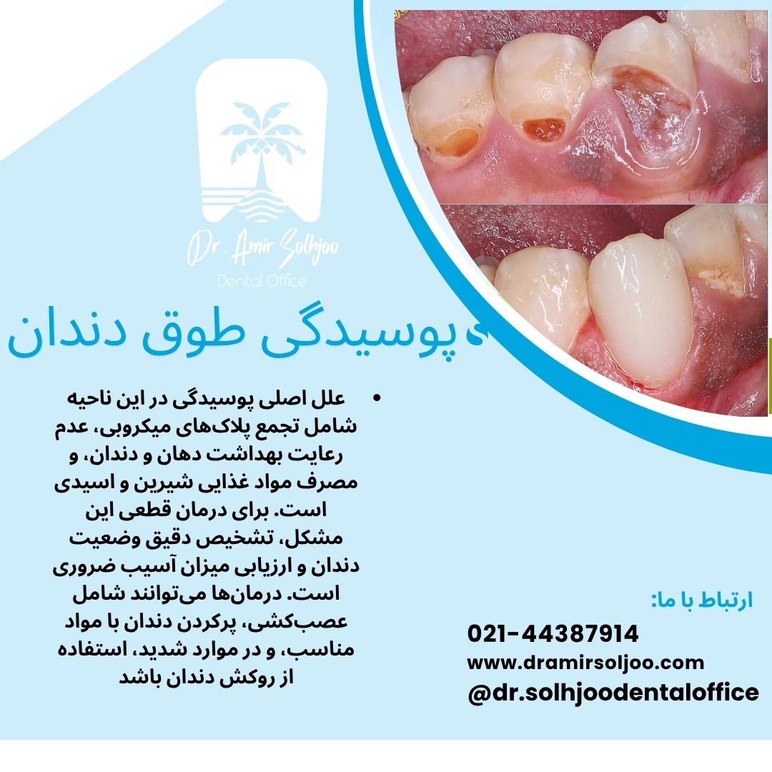 علت پوسیدگی طوق دندان