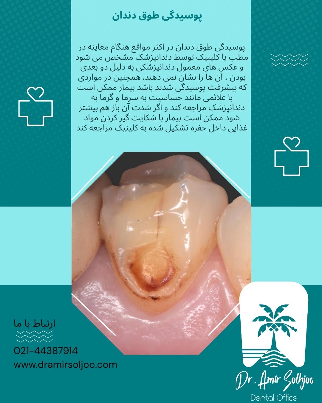 پوسیدگی طوق دندان