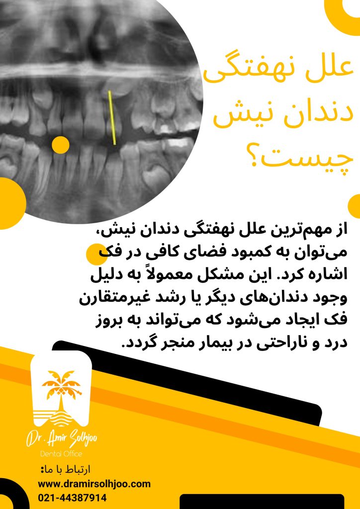 جراحی دندان نیش نهفته