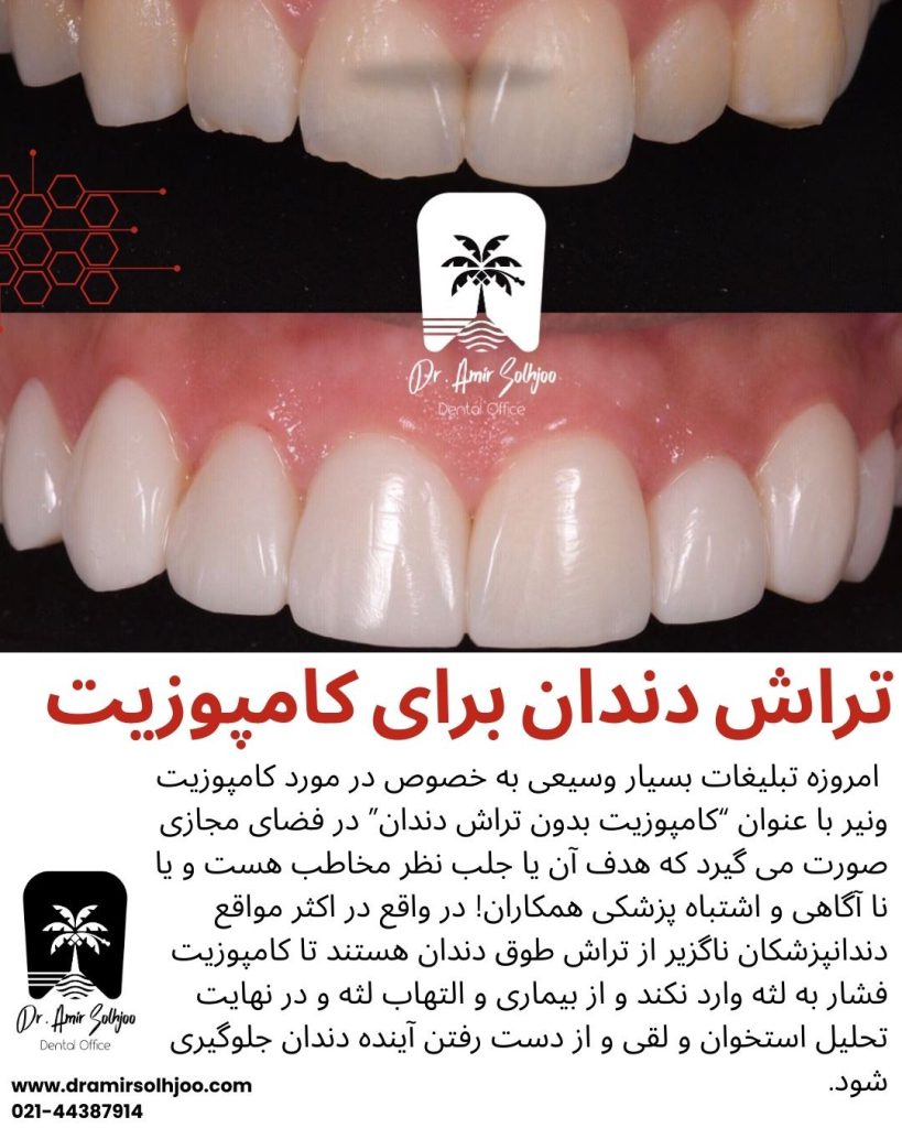 علت تراش دندان برای کامپوزیت