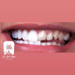 تراش دندان برای کامپوزیت