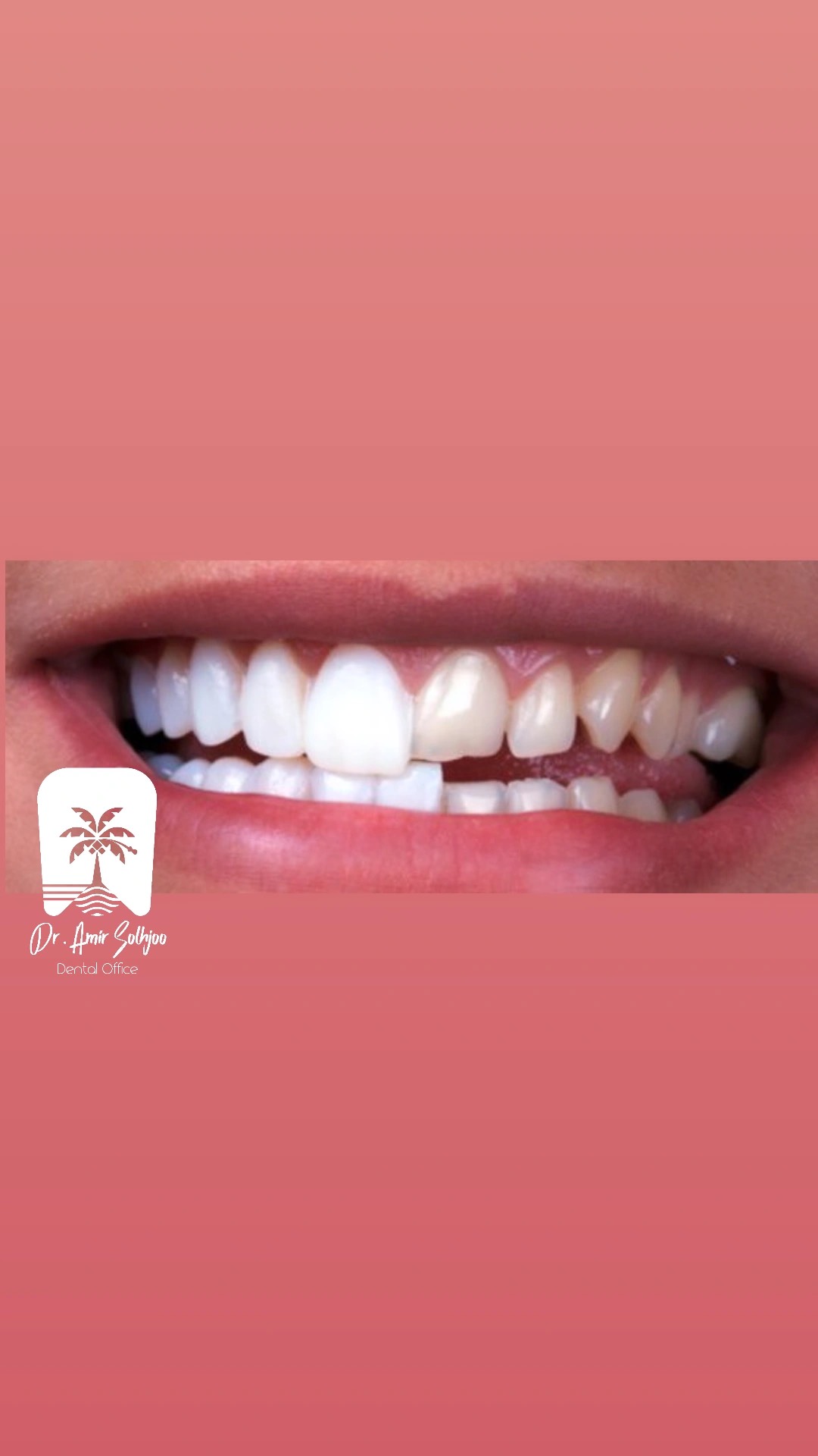 تراش دندان برای کامپوزیت