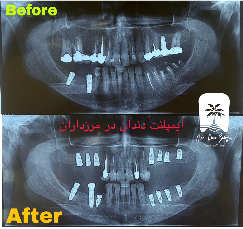 ایمپلنت در مرزداران