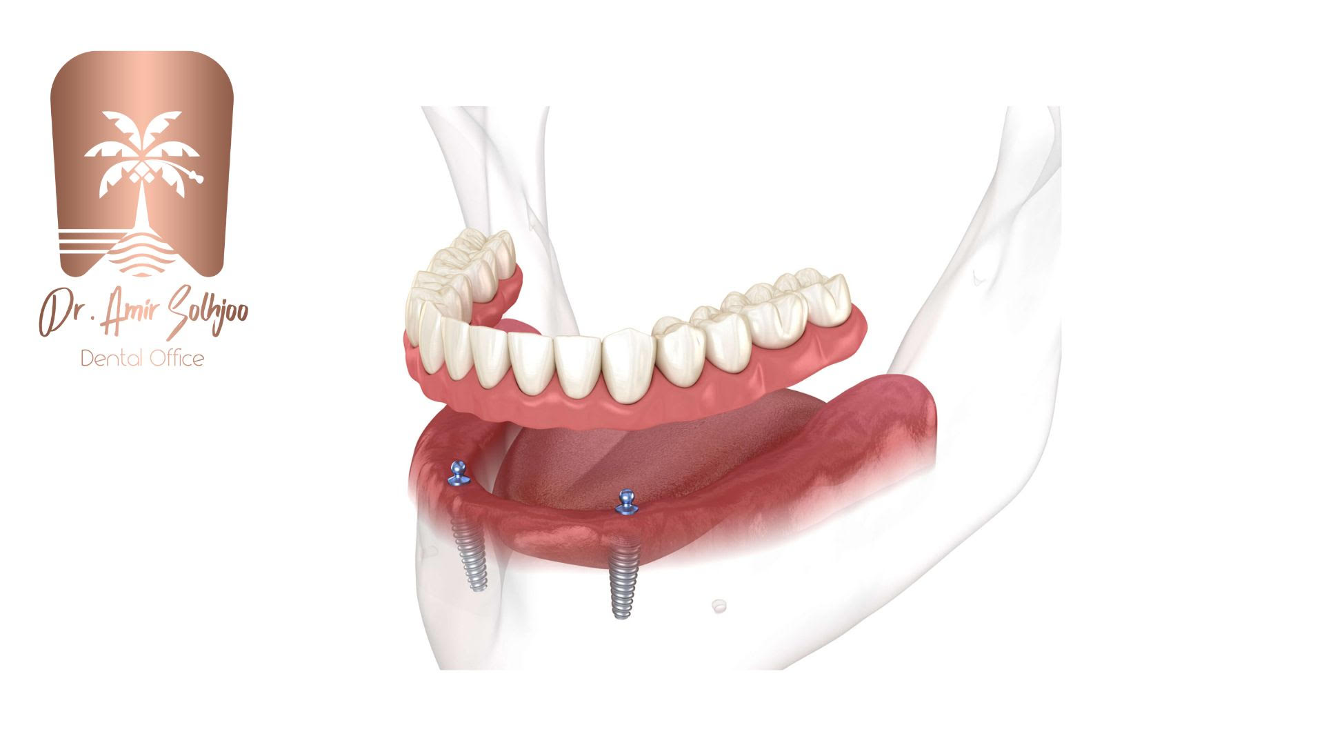 اوردنچر (Overdenture) چیست