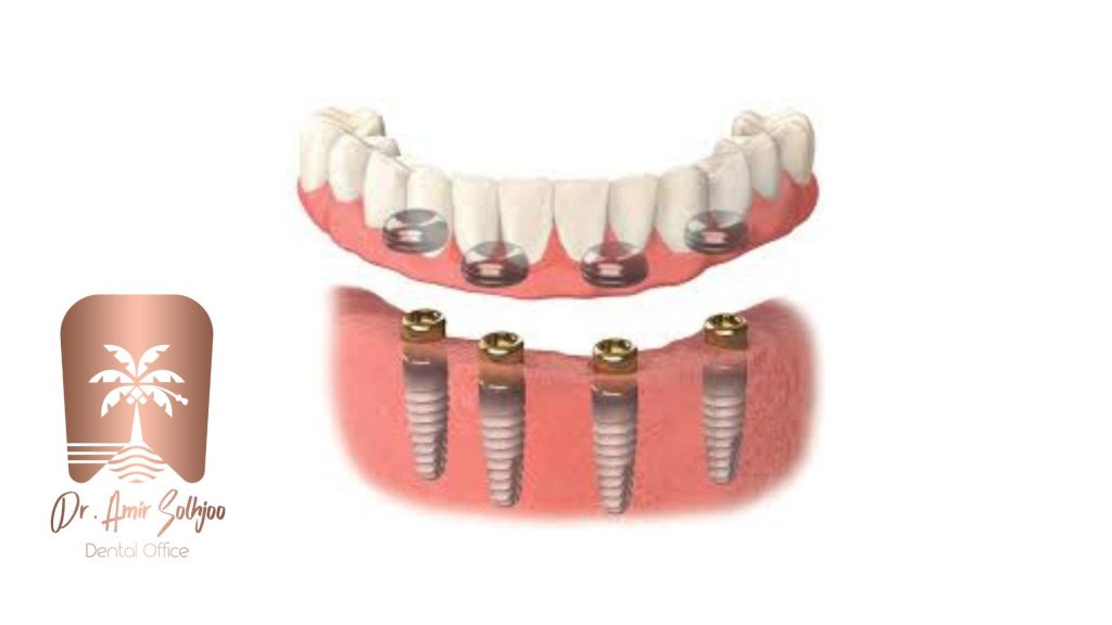 اوردنچر (Overdenture)