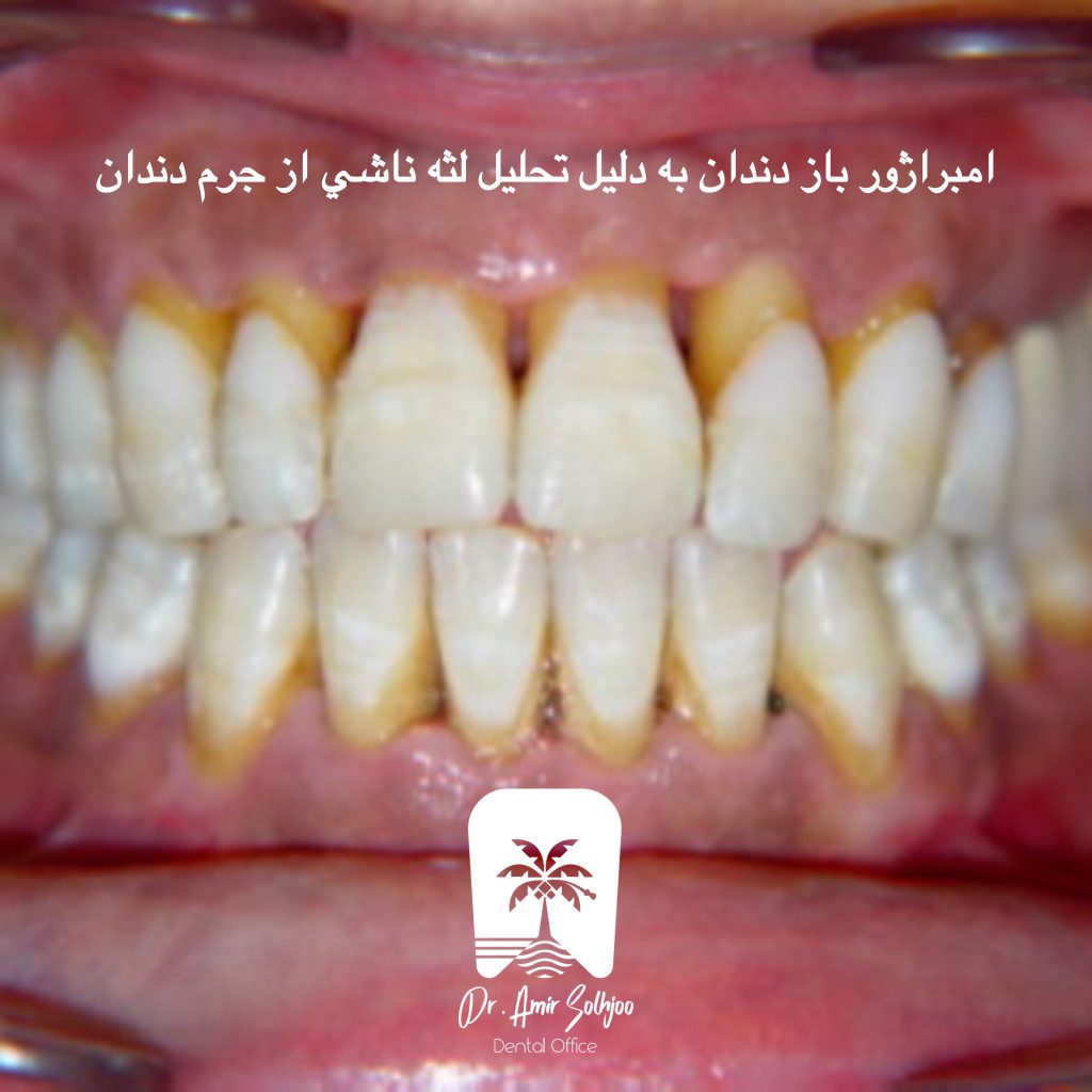 امبراژور باز دندان
