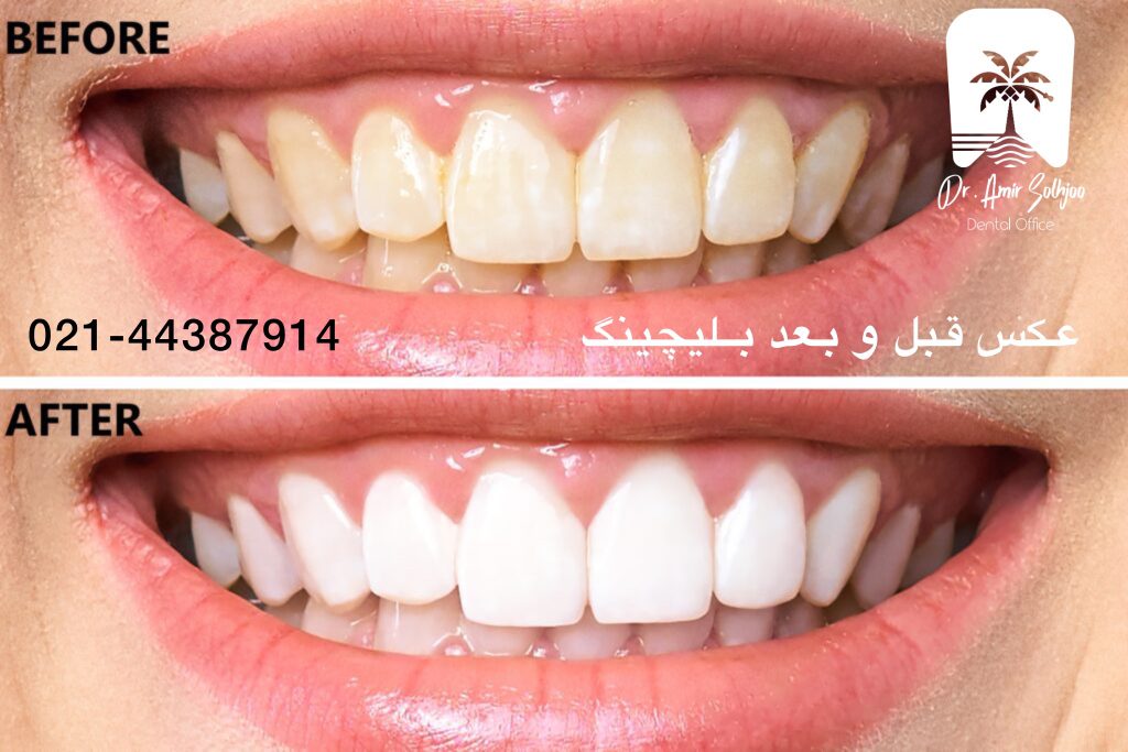 آفیس بلیچینگ چیست