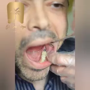 کاشت ایمپلنت