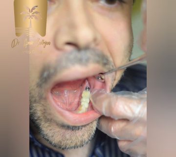 کاشت ایمپلنت