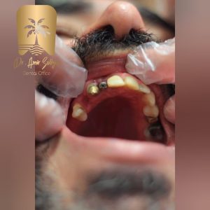 ایمپلنت